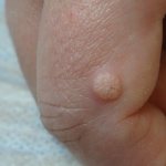 Flat wart on index finger