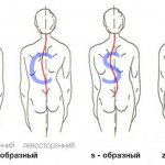 According to the shape of the bend, scoliosis is divided into three types