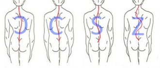 According to the shape of the bend, scoliosis is divided into three types