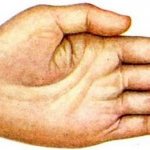causes signs symptoms diagnosis and treatment - Cyanosis causes, signs, symptoms, diagnosis and treatment