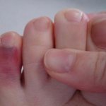 Signs of a broken toe