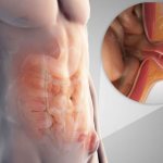 Signs of a strangulated hernia