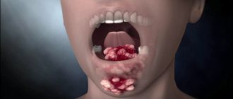Tongue cancer: symptoms and treatment