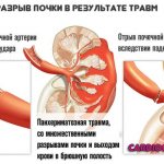 kidney rupture