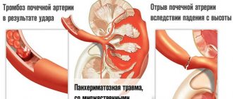 kidney rupture