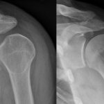 x-ray of the shoulder joint