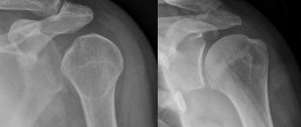 x-ray of the shoulder joint