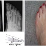 X-ray of the foot with hallux rigidus