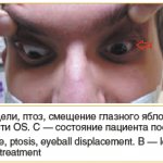 Rice. 1. Patient B.: A - narrowing of the palpebral fissure, ptosis, displacement of the eyeball to the left. B — increase in the size of the lacrimal gland on the left, limitation of OS mobility. C – patient’s condition after treatment 1. Patient B.: A — narrow palpebral fissure, ptosis, 