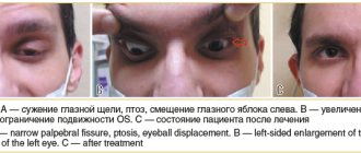 Rice. 1. Patient B.: A - narrowing of the palpebral fissure, ptosis, displacement of the eyeball to the left. B — increase in the size of the lacrimal gland on the left, limitation of OS mobility. C – patient’s condition after treatment 1. Patient B.: A — narrow palpebral fissure, ptosis, 