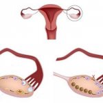 schematic representation of multifollicular ovaries