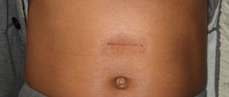 Suture after removal of abdominal hernia