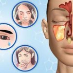 Symptoms of acute sinusitis