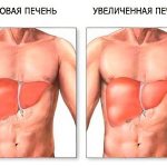 Symptoms of liver enlargement