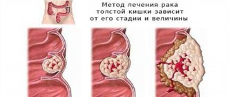 Stages of rectal cancer