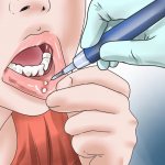 Stomatitis: why it occurs and how to treat it