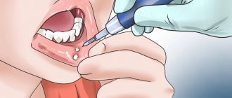 Stomatitis: why it occurs and how to treat it