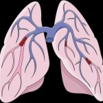 Pulmonary embolism (PE)