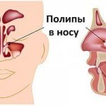 Removal of nasal polyps