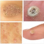 removal of viral warts