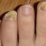 Утолщение ногтя часто сопровождается изменением цвета