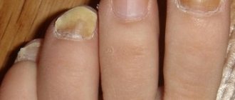 Thickening of the nail is often accompanied by a change in color