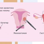 Варианты хирургического лечения миомы матки - Изображение №3
