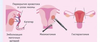 Варианты хирургического лечения миомы матки - Изображение №3
