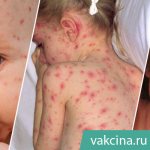Chickenpox (varicella, chickenpox) in children and adults