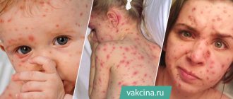 Chickenpox (varicella, chickenpox) in children and adults