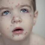 Chickenpox in a child