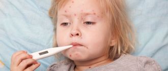 Chickenpox (varicella) - Pediatric care in the Network of Clinics JSC Family Doctor (Moscow) - Photo 1