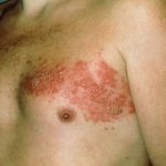 Vesicular rash associated with herpes zoster