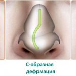 types of deviated nasal septum