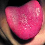 Sore tongue