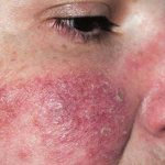 Rash on the cheek is the first sign of eczema