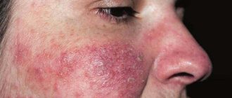 Rash on the cheek is the first sign of eczema