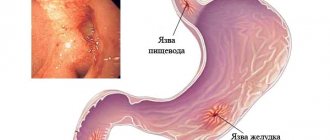 An ulcer appears as a result of increased acidity, an increase in the content of hydrochloric acid in the stomach.