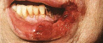 Ulcerative tuberculosis.