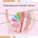 Curvature of the uterus - Image #1