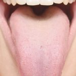 yellow coating on the throat of the tongue